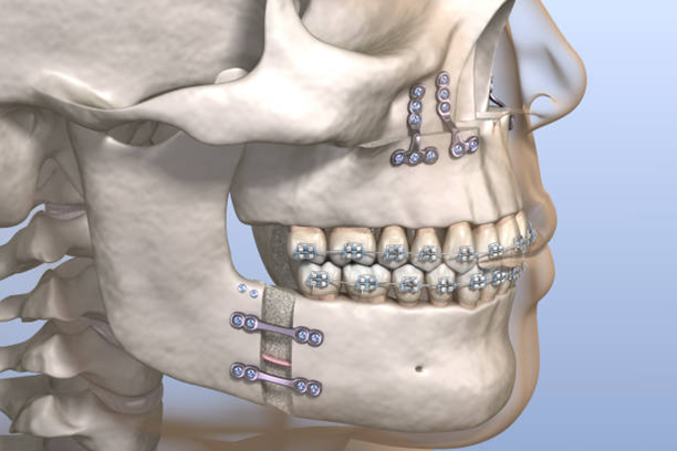 Orthognathic-Jaw-Surgery1